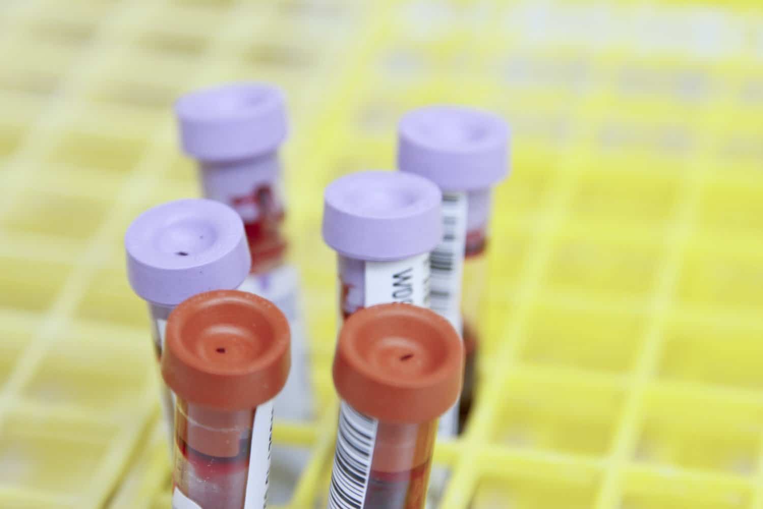 Photo of vials of blood